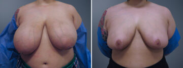 Before and after Breast Reduction by Dr. David W. Allison, Patient 6290