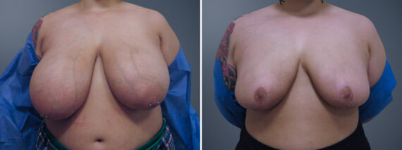 Before and after Breast Reduction by Dr. David W. Allison, Patient 6290