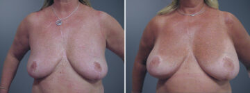Before and after Breast Augmentation by Dr. David W. Allison, Patient 6301