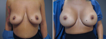Before and after Breast Augmentation by Dr. David W. Allison, Patient 6305