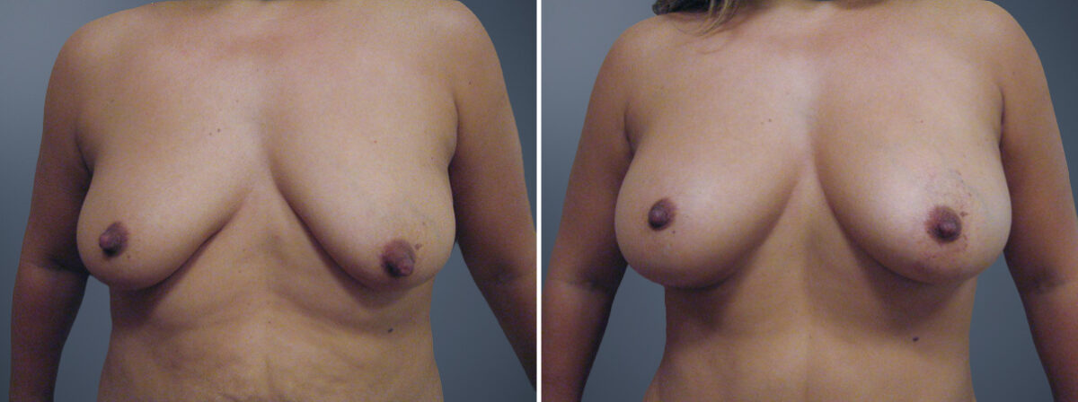 Before and after Breast Augmentation by Dr. David W. Allison, Patient 6310
