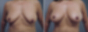 Before and after Breast Augmentation by Dr. David W. Allison, Patient 6310