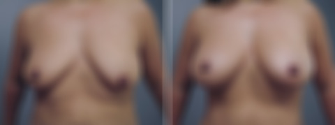 Before and after Breast Augmentation by Dr. David W. Allison, Patient 6310