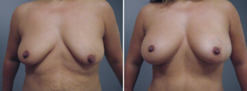 Before and after Breast Augmentation by Dr. David W. Allison, Patient 6310