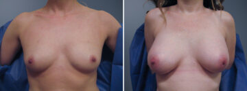 Before and after Breast Augmentation by Dr. David W. Allison, Patient 6314