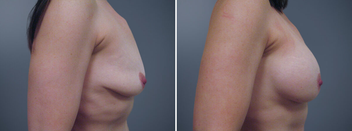 Before and after Breast Augmentation by Dr. David W. Allison, Patient 6318