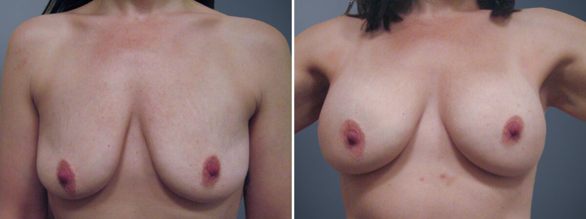 Before and after Breast Augmentation by Dr. David W. Allison, Patient 6318