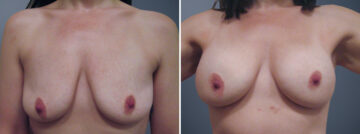 Before and after Breast Augmentation by Dr. David W. Allison, Patient 6318