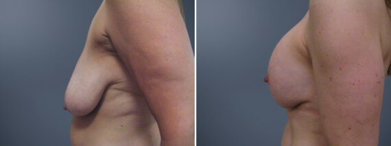 Breast Lift before and after photos in Princeton, NJBreast Lift Before and After Photos in Princeton, NJ