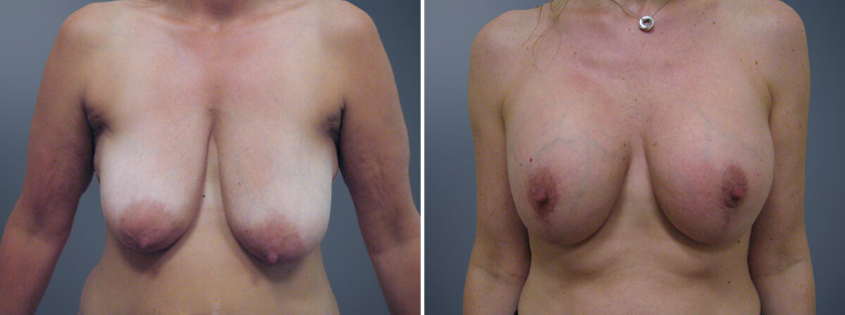 Before and after Breast Augmentation by Dr. David W. Allison, Patient 6329