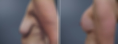 Before and after Breast Augmentation by Dr. David W. Allison, Patient 6329