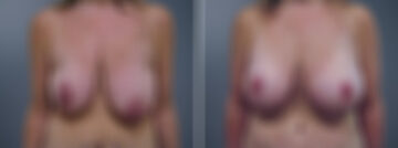Before and after Breast Augmentation by Dr. David W. Allison, Patient 6336