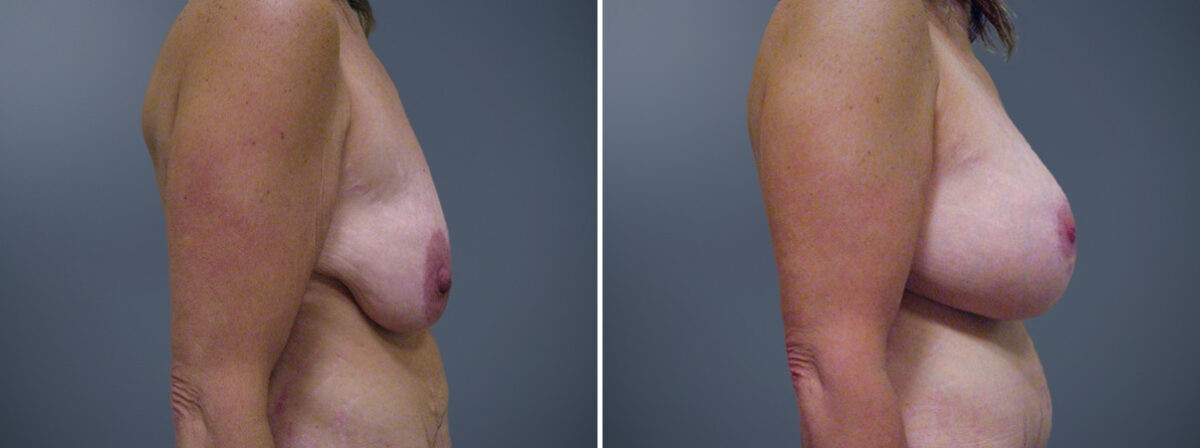 Before and after Breast Augmentation by Dr. David W. Allison, Patient 6336