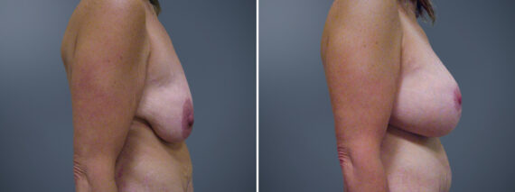 Breast Lift before and after photos in Princeton, NJBreast Lift Before and After Photos in Princeton, NJ