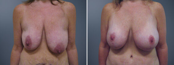 Before and after Breast Augmentation by Dr. David W. Allison, Patient 6336