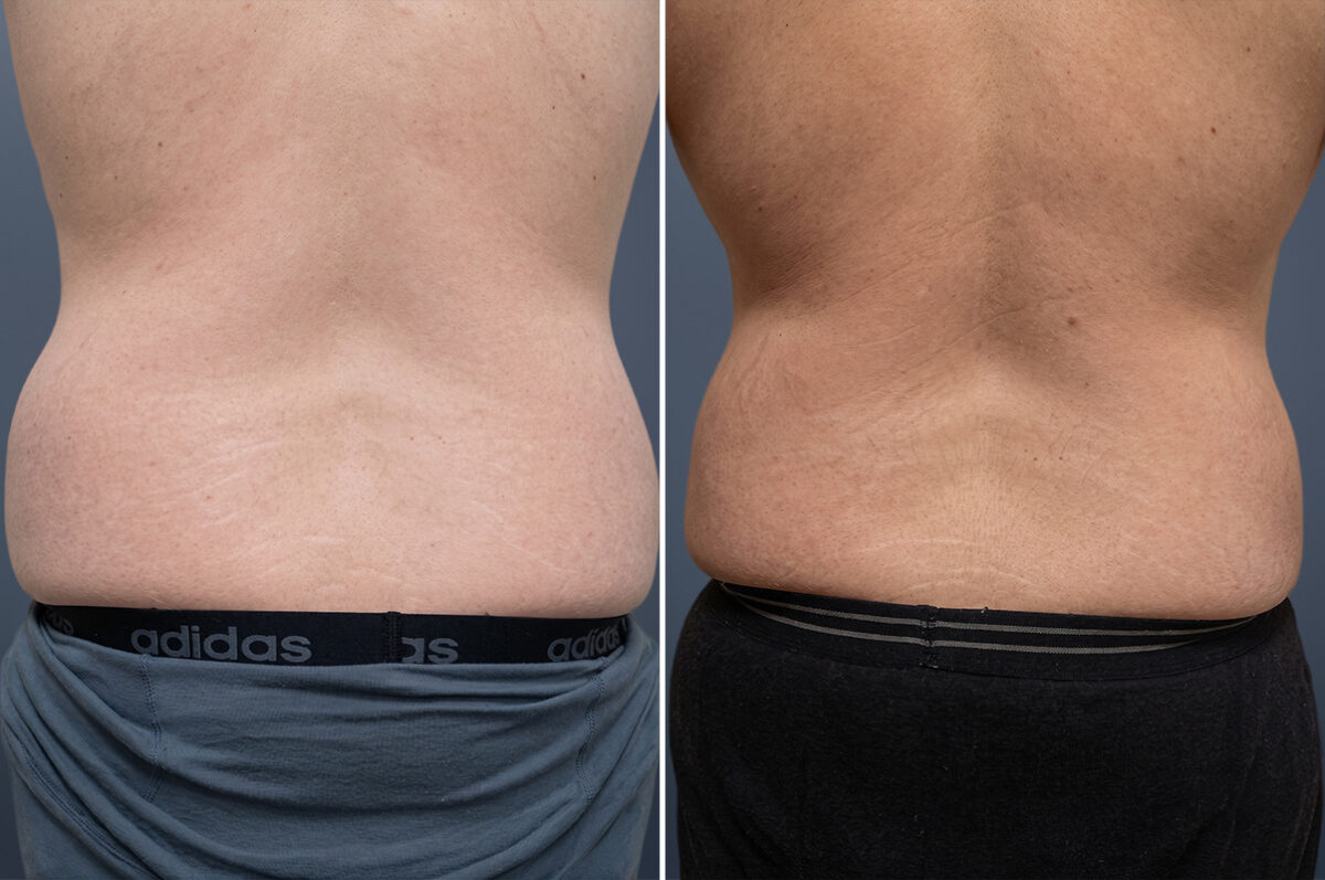 Before and after Liposuction by Dr. David W. Allison, Patient 6357