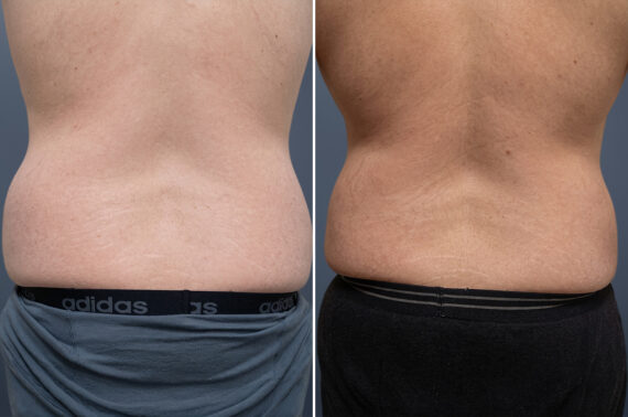 Before and after Liposuction by Dr. David W. Allison, Patient 6357