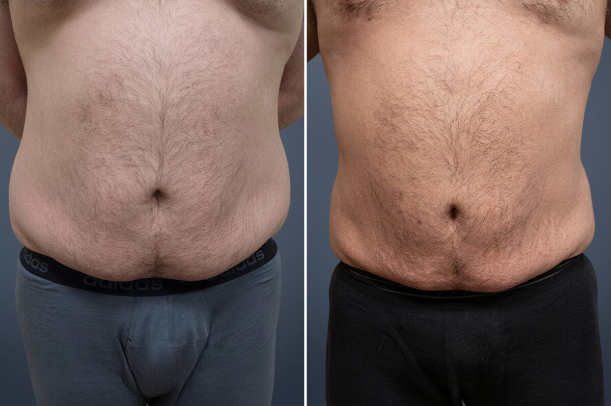 Before and after Liposuction by Dr. David W. Allison, Patient 6357