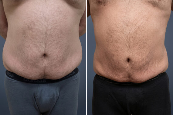 Before and after Liposuction by Dr. David W. Allison, Patient 6357