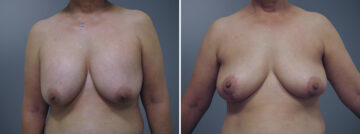 Before and after Breast Reduction by Dr. David W. Allison, Patient 6370