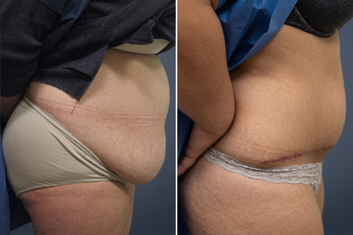 Before and after Tummy Tuck by Dr. David W. Allison, Patient 6740
