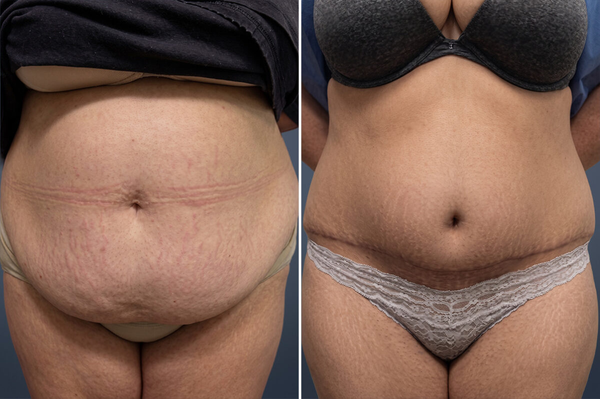 Before and after Tummy Tuck by Dr. David W. Allison, Patient 6740