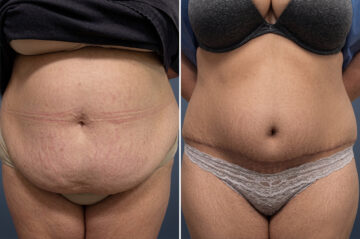 Before and after Tummy Tuck by Dr. David W. Allison, Patient 6740