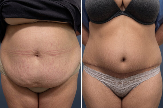 Before and after Tummy Tuck by Dr. David W. Allison, Patient 6740