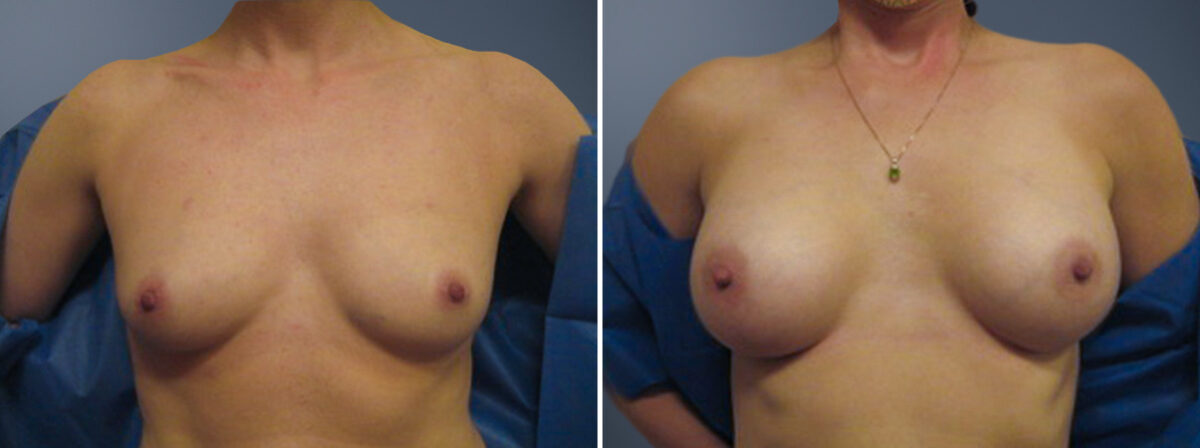 Before and after Breast Augmentation by Dr. David W. Allison, Patient 6750