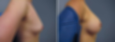 Before and after Breast Augmentation by Dr. David W. Allison, Patient 6750