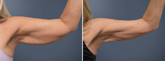 Before and after Arm Liposuction by Dr. David W. Allison, Patient 6765