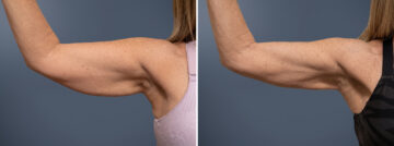 Before and after Arm Liposuction by Dr. David W. Allison, Patient 6765