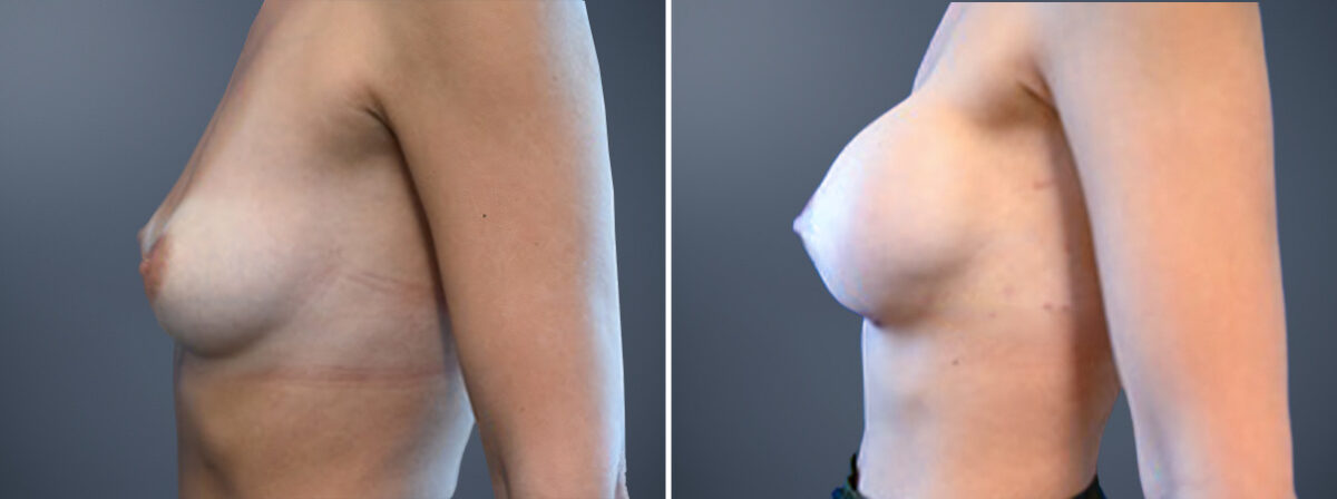 Before and after Breast Augmentation by Dr. David W. Allison, Patient 6772
