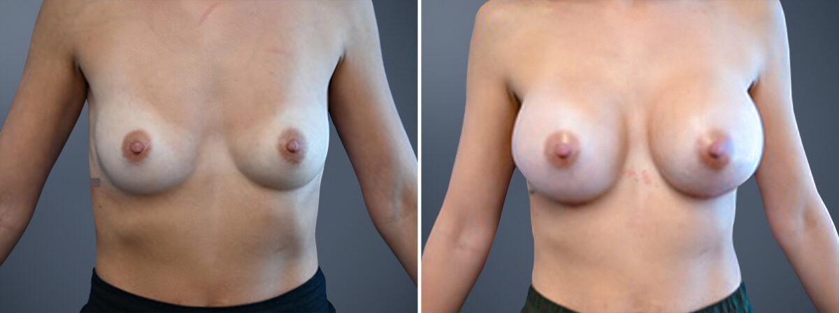 Before and after Breast Augmentation by Dr. David W. Allison, Patient 6772