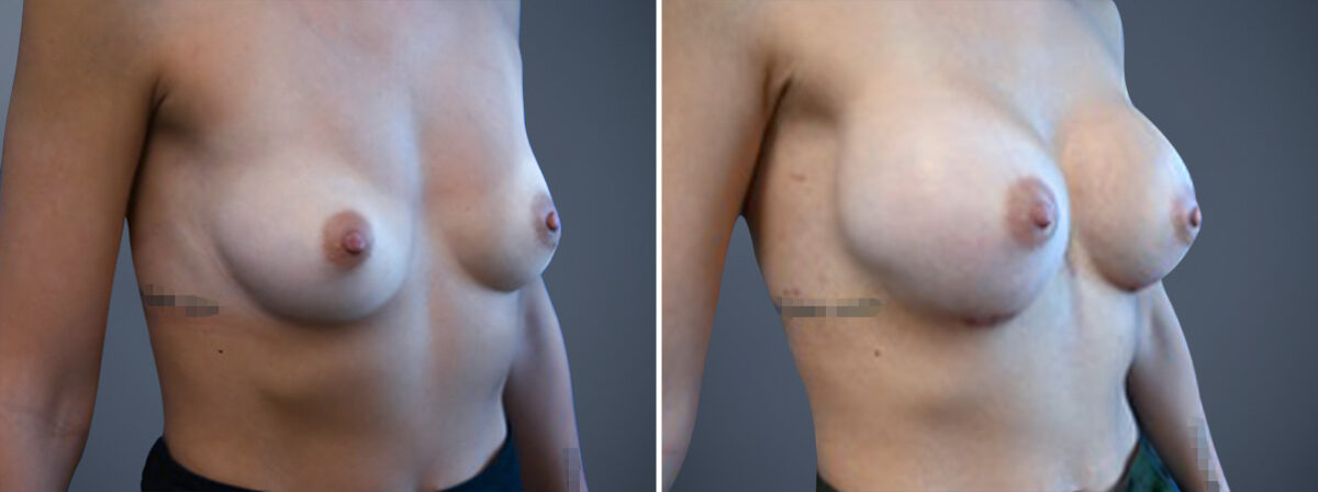 Before and after Breast Augmentation by Dr. David W. Allison, Patient 6772