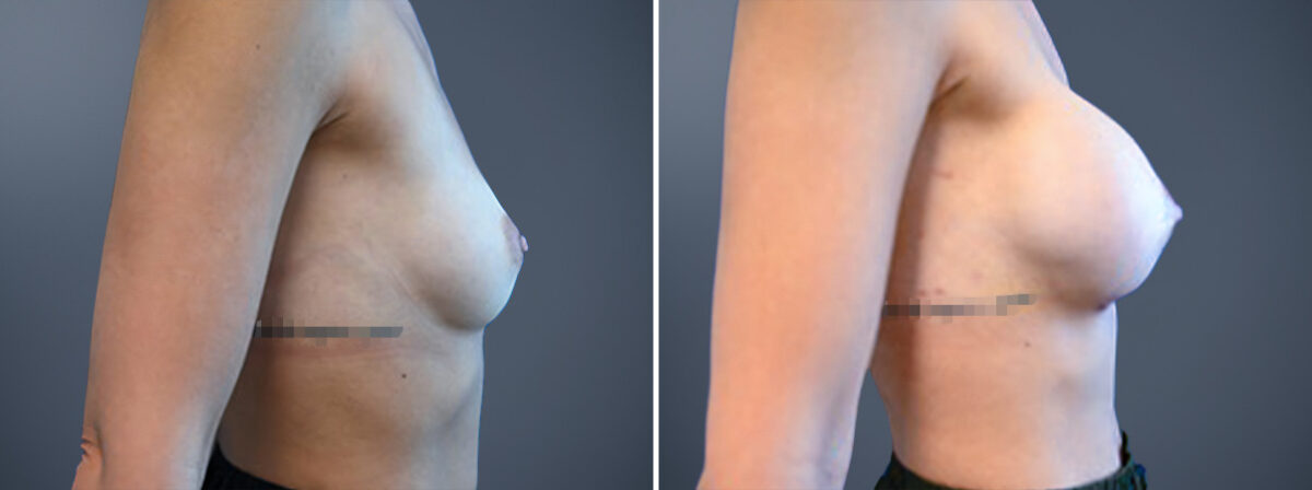 Before and after Breast Augmentation by Dr. David W. Allison, Patient 6772