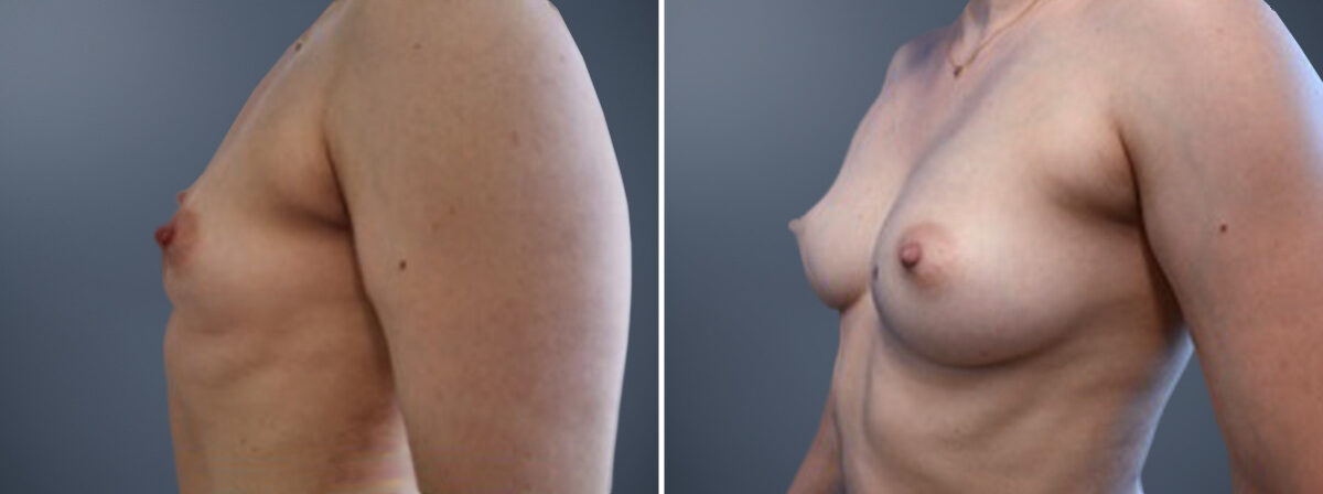 Before and after Breast Augmentation by Dr. David W. Allison, Patient 6796