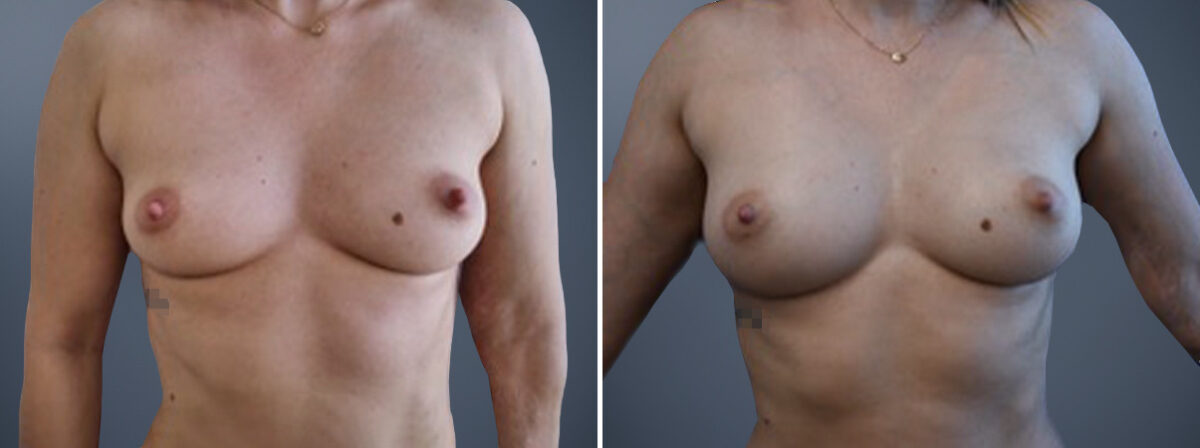 Before and after Breast Augmentation by Dr. David W. Allison, Patient 6796