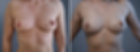 Before and after Breast Augmentation by Dr. David W. Allison, Patient 6796
