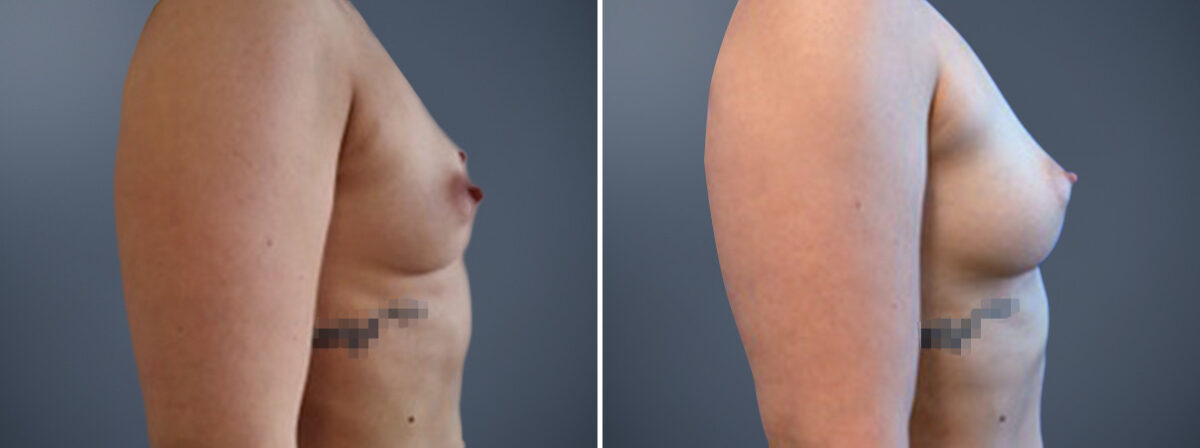 Before and after Breast Augmentation by Dr. David W. Allison, Patient 6796