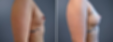 Before and after Breast Augmentation by Dr. David W. Allison, Patient 6796