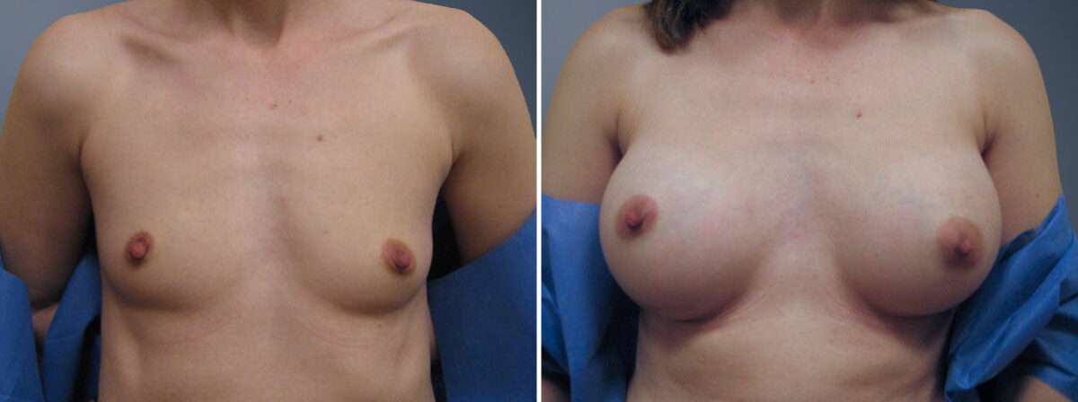 Before and after Breast Augmentation by Dr. David W. Allison, Patient 6814