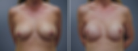 Before and after Breast Augmentation by Dr. David W. Allison, Patient 6823