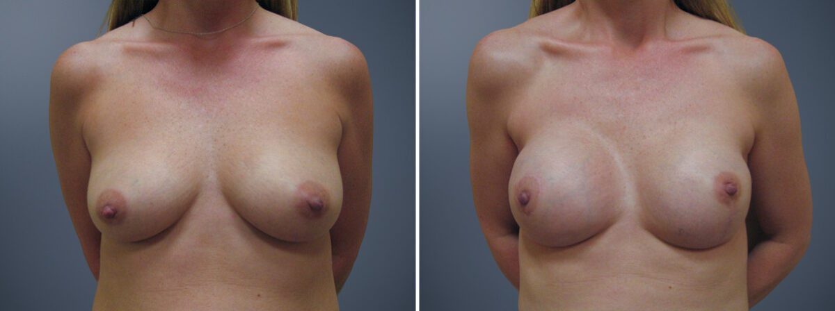 Before and after Breast Augmentation by Dr. David W. Allison, Patient 6823