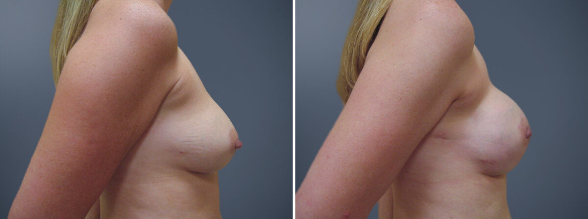 Before and after Breast Augmentation by Dr. David W. Allison, Patient 6823