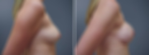Before and after Breast Augmentation by Dr. David W. Allison, Patient 6823