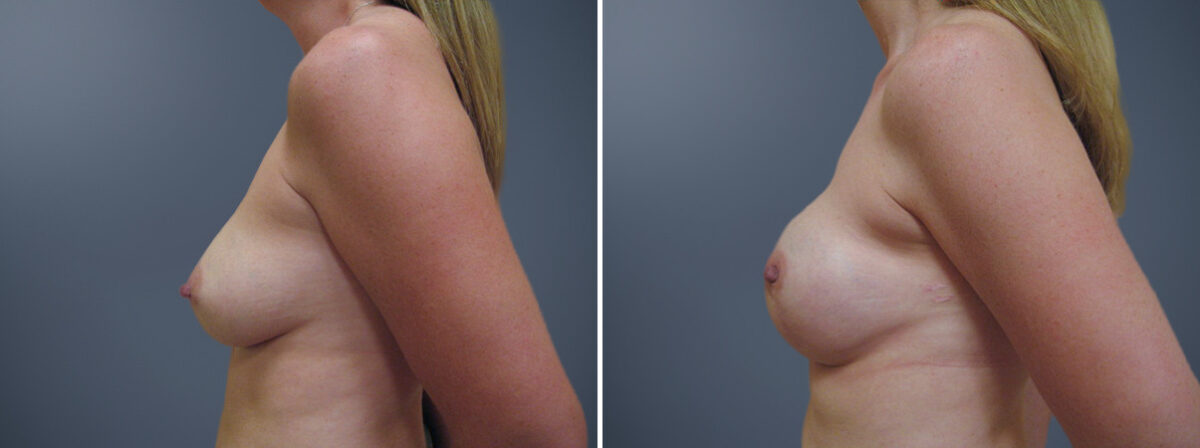 Before and after Breast Augmentation by Dr. David W. Allison, Patient 6823