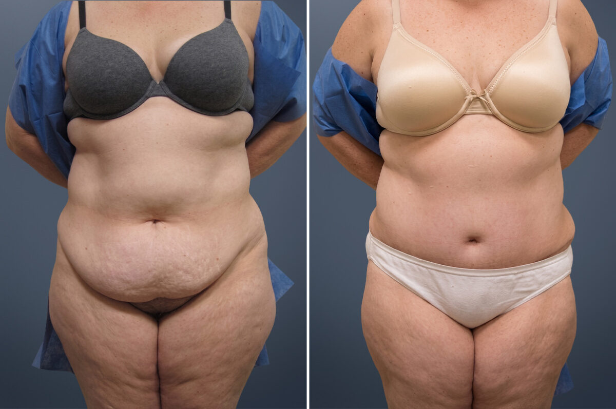 Before and after Tummy Tuck by Dr. David W. Allison, Patient 6839
