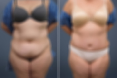 Before and after Tummy Tuck by Dr. David W. Allison, Patient 6839