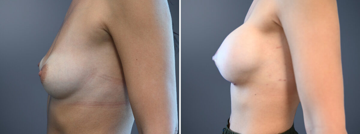 Before and after Breast Augmentation by Dr. David W. Allison, Patient 6772